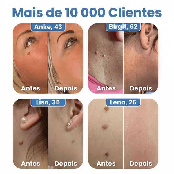 Warzenfrei Removedor de Verrugas Fácil